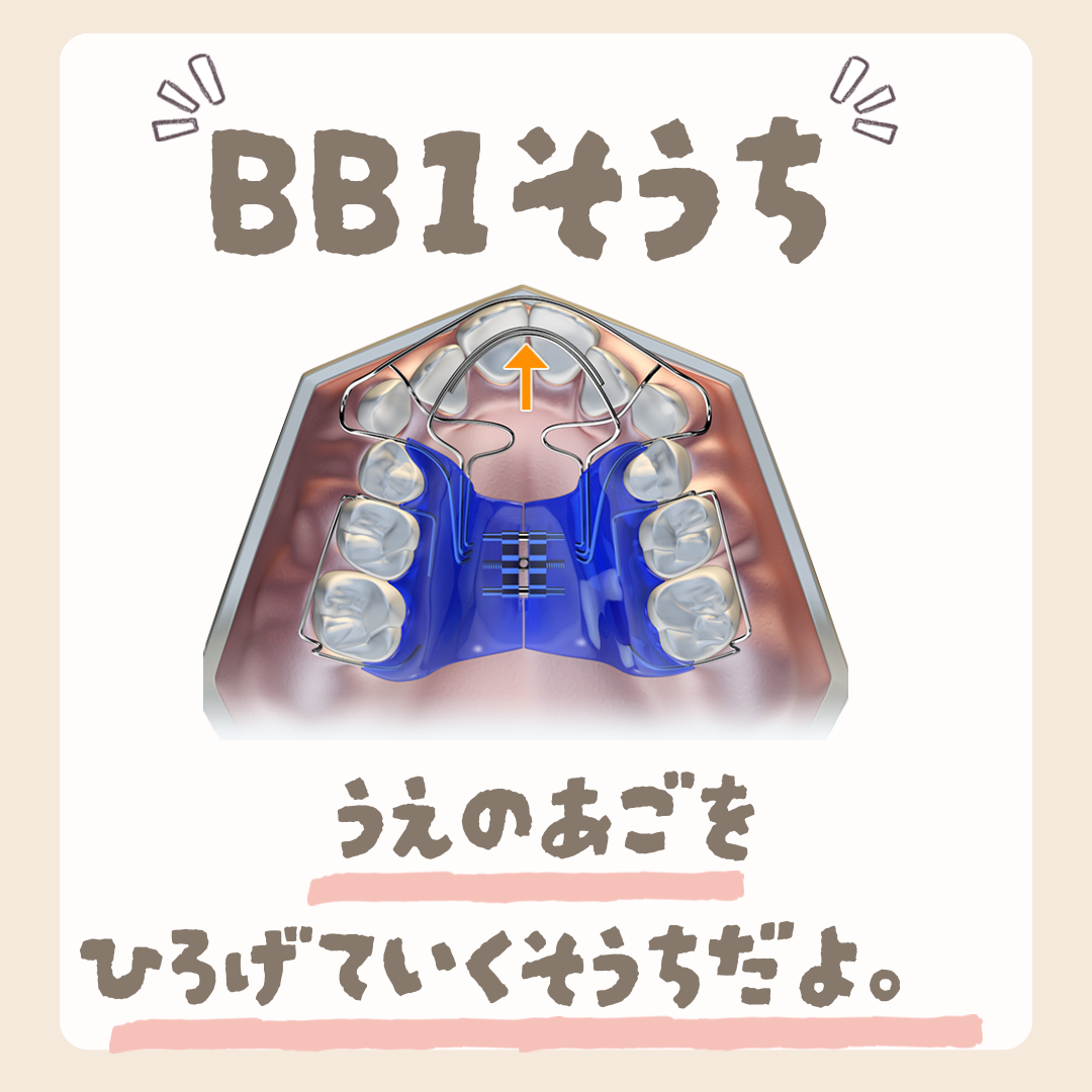 BB1装置について